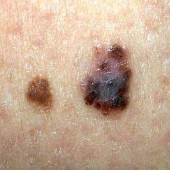 Melanoma